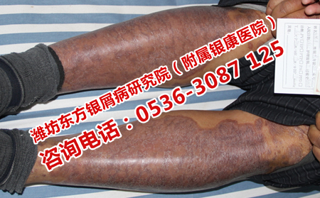 寻常型银屑病去哪里治