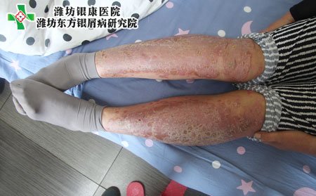牛皮癣预防,冬季牛皮癣的预防